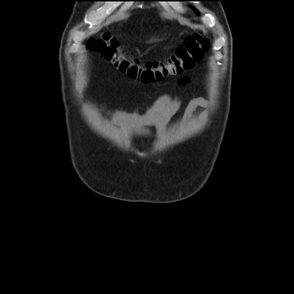 File:Active colonic bleed on CT (Radiopaedia 49765-55025 Coronal non-contrast 9).jpg