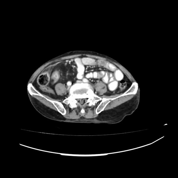 File:Acute-on-chronic Crohn disease with enteroenteric fistula (Radiopaedia 66686-75987 B 31).jpg