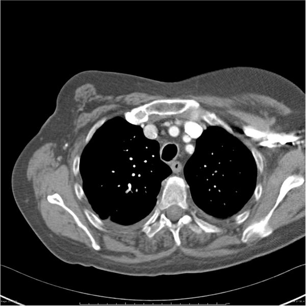 File:Acute-on-chronic pulmonary emboli (Radiopaedia 27925-28169 C+ CTPA 17).jpg