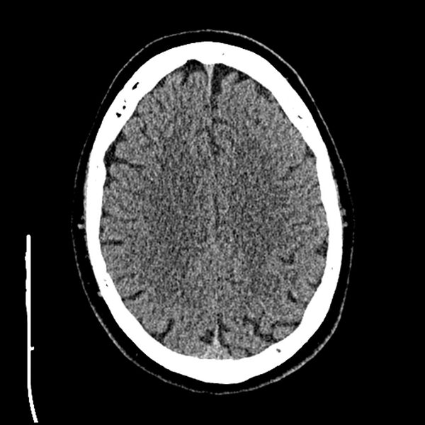 File:Acute A3 occlusion with ACA ischemic penumbra (CT perfusion) (Radiopaedia 72036-82525 Axial non-contrast thins 75).jpg