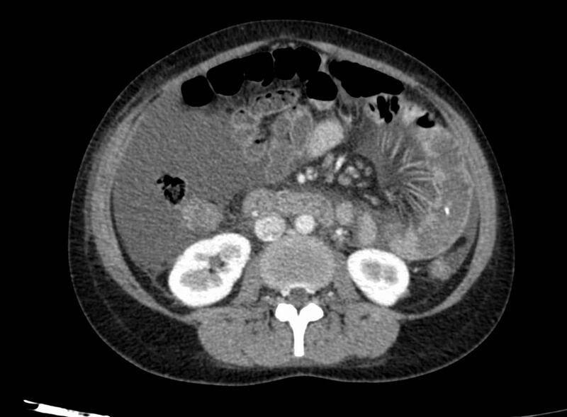 File:Acute Budd-Chiari syndrome (Radiopaedia 60858-68638 Axial C+ portal venous phase 150).jpg