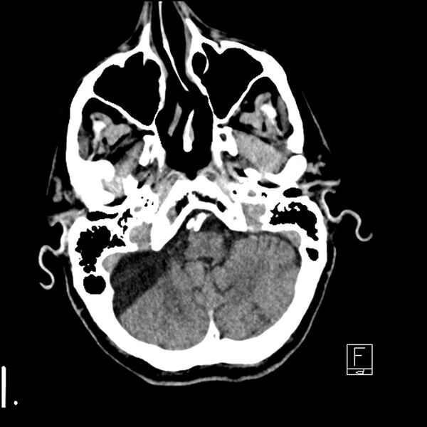 File:Acute ICA ischemic penumbra due to high-grade CCA stenosis (CT perfusion) (Radiopaedia 72038-82529 Axial non-contrast 7).jpg