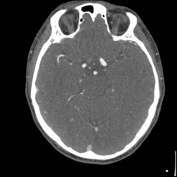 File:Acute P1 occlusion with PCA ischemia penumbra (CT perfusion) (Radiopaedia 72084-82587 Axial C+ arterial thins 44).jpg