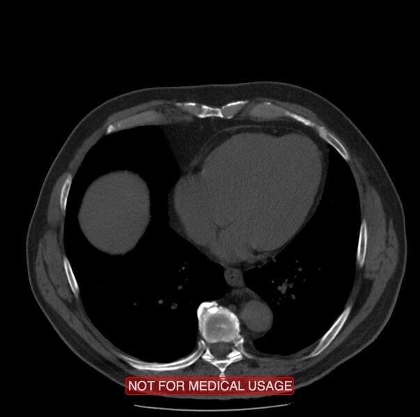 File:Acute aortic dissection - Stanford type A (Radiopaedia 40661-43285 Axial non-contrast 46).jpg