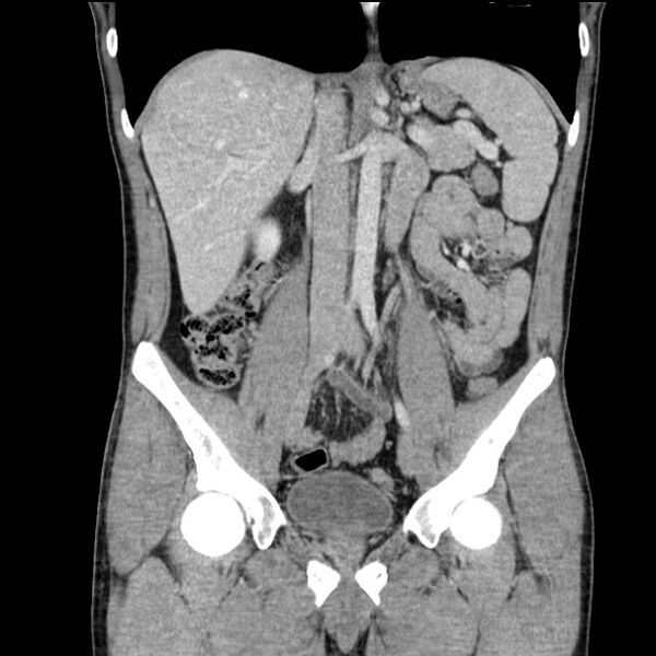 File:Acute appendicitis (Radiopaedia 27049-27227 Coronal C+ portal venous phase 28).jpg
