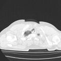 Acute aspiration pneumonitis (Radiopaedia 33605-34703 Axial lung window 13).jpg