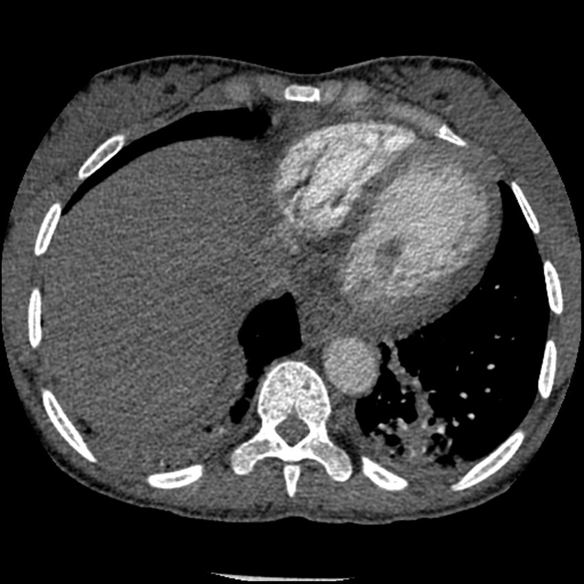 Acute chest syndrome - sickle cell disease (Radiopaedia 42375-45499 Axial C+ CTPA 148).jpg