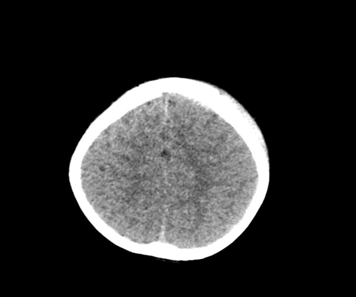 File:Acute epidural hematoma (Radiopaedia 63659-72335 Axial non-contrast 21).jpg