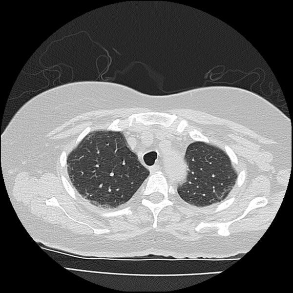 File:Acute interstitial pneumonitis (Radiopaedia 45404-49452 Axial lung window 19).jpg