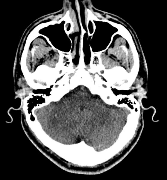 File:Acute ischemic stroke - posterior circulation territory (Radiopaedia 77670-89881 non-contrast 17).jpg