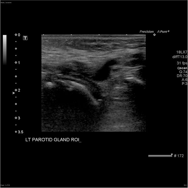 File:Acute left parotid sialadenitis (Radiopaedia 26160-26296 A 1).jpg