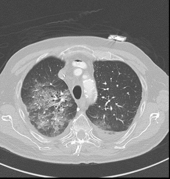 File:Acute myocardial infarction (Radiopaedia 23413-23481 lung window 3).jpg