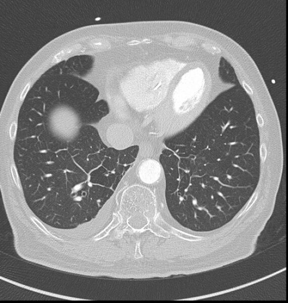 File:Acute myocardial infarction (Radiopaedia 23413-23481 lung window 56).jpg