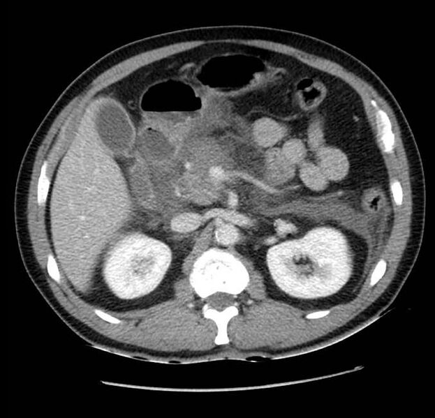 File:Acute pancreatitis - Balthazar E (Radiopaedia 23080-23110 Axial C+ portal venous phase 24).jpg