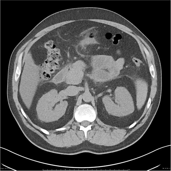 File:Acute pancreatitis - mild (Radiopaedia 27796-28033 Axial non-contrast 13).jpg
