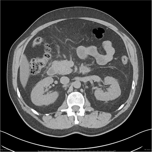 File:Acute pancreatitis - mild (Radiopaedia 27796-28033 Axial non-contrast 16).jpg