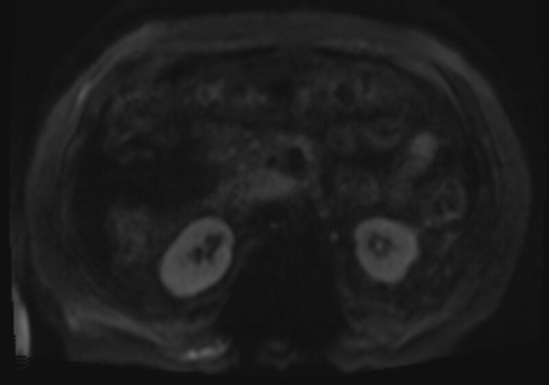 File:Acute portal vein thrombosis (Radiopaedia 73198-83925 Axial DWI 52).jpg