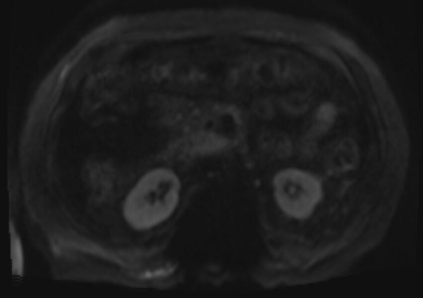 Acute portal vein thrombosis (Radiopaedia 73198-83925 Axial DWI 52).jpg