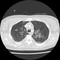Acute pulmonary edema on CT (Radiopaedia 33582-34672 Axial lung window 12).jpg