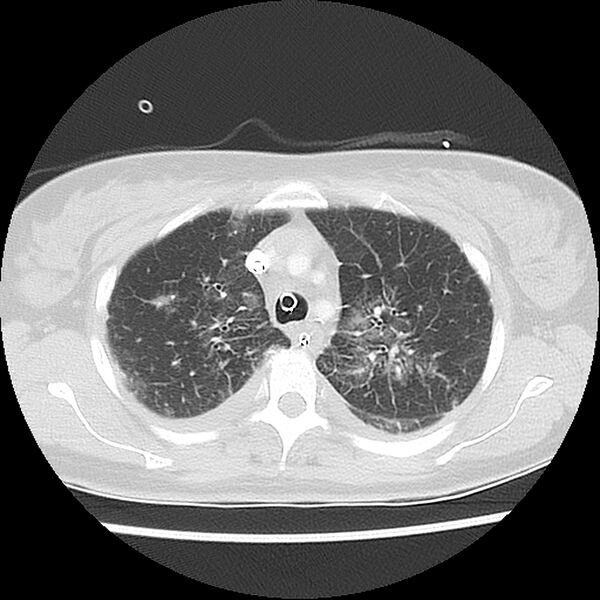 File:Acute pulmonary edema on CT (Radiopaedia 33582-34672 Axial lung window 12).jpg