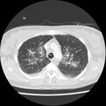 Acute pulmonary edema on CT (Radiopaedia 33582-34672 Axial lung window 14).jpg