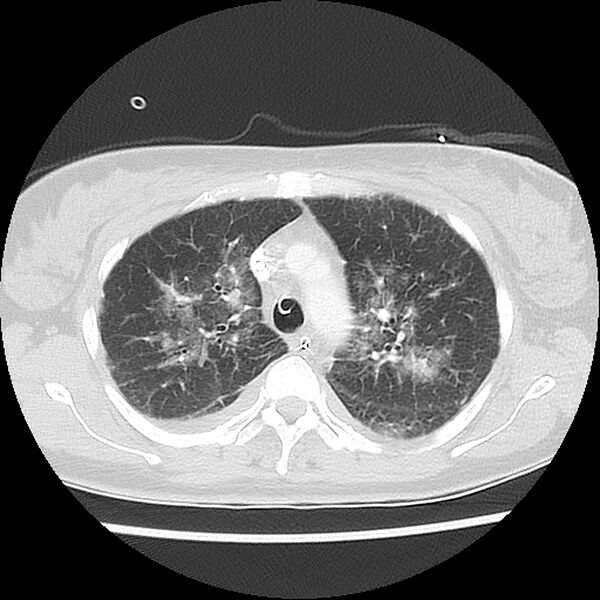 File:Acute pulmonary edema on CT (Radiopaedia 33582-34672 Axial lung window 14).jpg