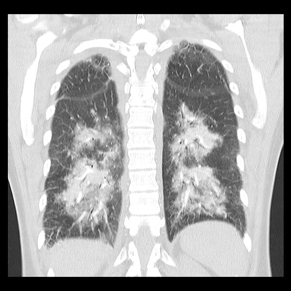 File:Acute pulmonary edema on CT (Radiopaedia 33582-34672 Coronal lung window 29).jpg