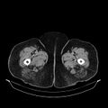 Acute pyelonephritis (Radiopaedia 25657-25837 Axial renal parenchymal phase 93).jpg