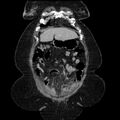 Acute pyelonephritis (Radiopaedia 25657-25837 Coronal renal parenchymal phase 24).jpg