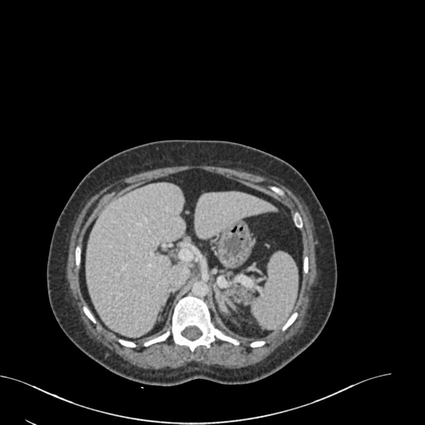 Acute pyelonephritis with renal vein thrombosis (Radiopaedia 58020-65053 Axial renal parenchymal phase 5).jpg