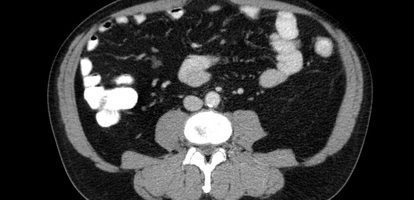 Acute sigmoid colon diverticulitis (Radiopaedia 55507-61976 Axial C+ portal venous phase 33).jpg