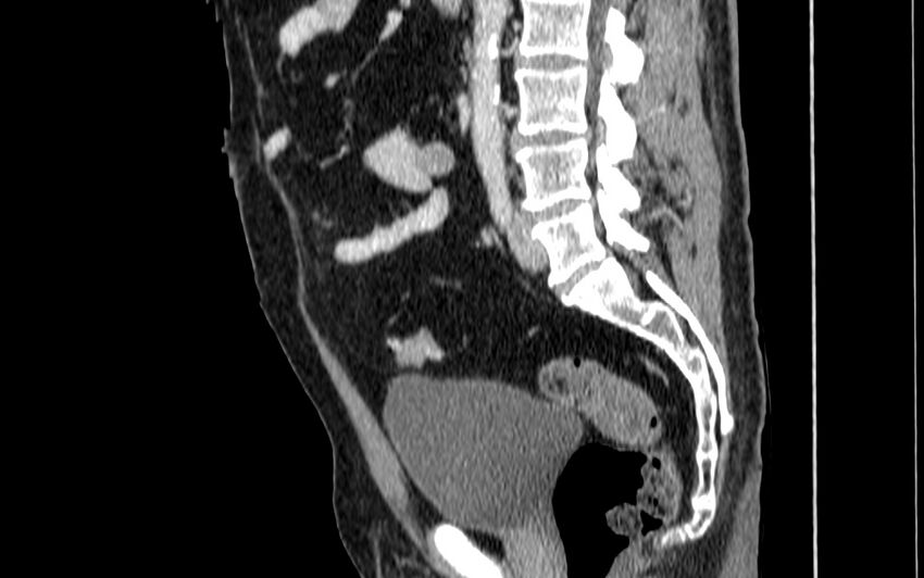 Acute sigmoid colon diverticulitis (Radiopaedia 55507-61976 Sagittal C+ portal venous phase 7).jpg