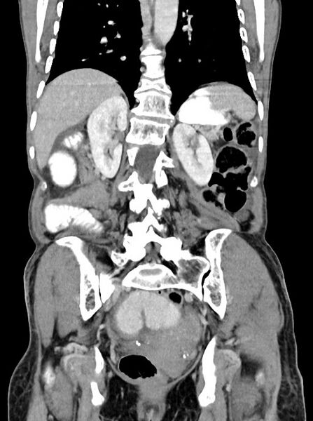 File:Acute small bowel (ileal) volvulus (Radiopaedia 71740-82139 Coronal C+ portal venous phase 80).jpg