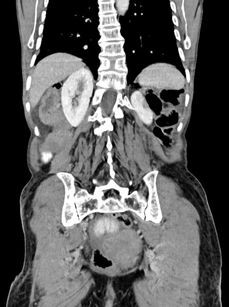 File:Acute small bowel (ileal) volvulus (Radiopaedia 71740-82139 Coronal C+ portal venous phase 86).jpg