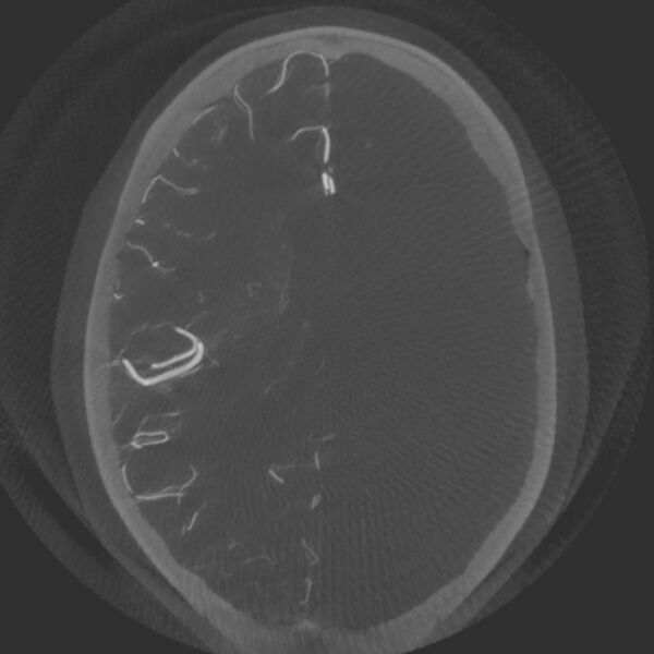 File:Acute subarachnoid hemorrhage and accessory anterior cerebral artery (Radiopaedia 69231-79010 Axial arterial - MIP 49).jpg