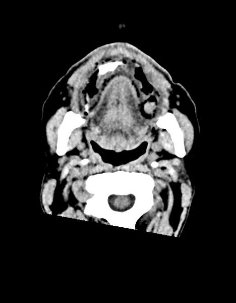 File:Acute superior cerebellar artery territory infarct (Radiopaedia 84104-99359 Axial non-contrast 75).jpg