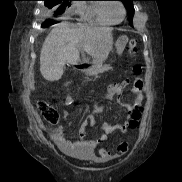File:Acute tubular necrosis (Radiopaedia 28077-28334 D 31).jpg