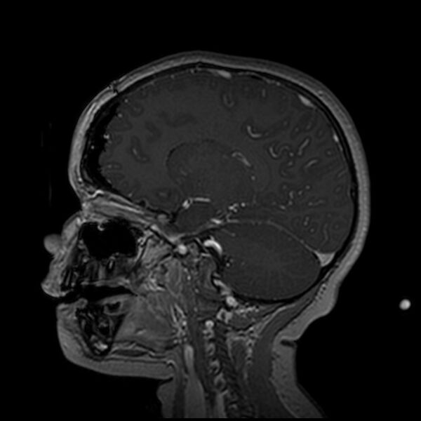 File:Adamantinomatous craniopharyngioma (Radiopaedia 77407-89529 H 49).jpg