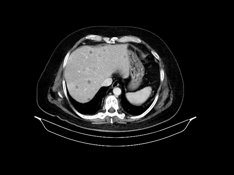 File:Adenocarcinoma of pancreas with hepatic metastasis (Radiopaedia 64332-73122 Axial C+ portal venous phase 17).jpg