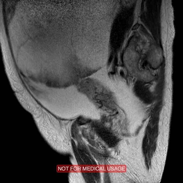 File:Adenocarcinoma of the cervix (Radiopaedia 28373-28615 Sagittal T2 14).jpg