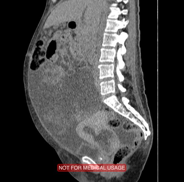 File:Adenocarcinoma of the cervix (Radiopaedia 28373-28616 Sagittal C+ delayed 1).jpg