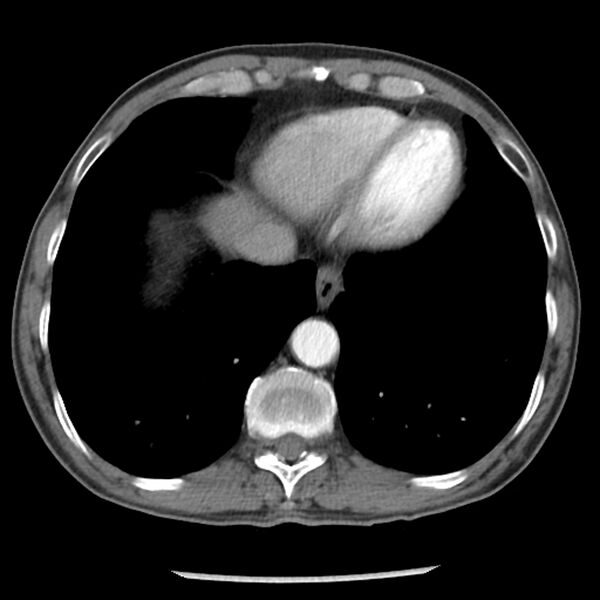 File:Adenocarcinoma of the lung - micropapillary predominant (Radiopaedia 42446-45563 Axial C+ portal venous phase 59).jpg
