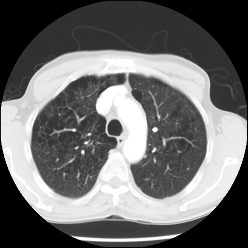 Adenocarcinoma of the lung - micropapillary predominant (Radiopaedia 42446-45563 Axial lung window 20).jpg