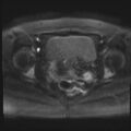 Adenomyosis and endometriotic cysts (Radiopaedia 82300-96367 Axial DWI 26).jpg