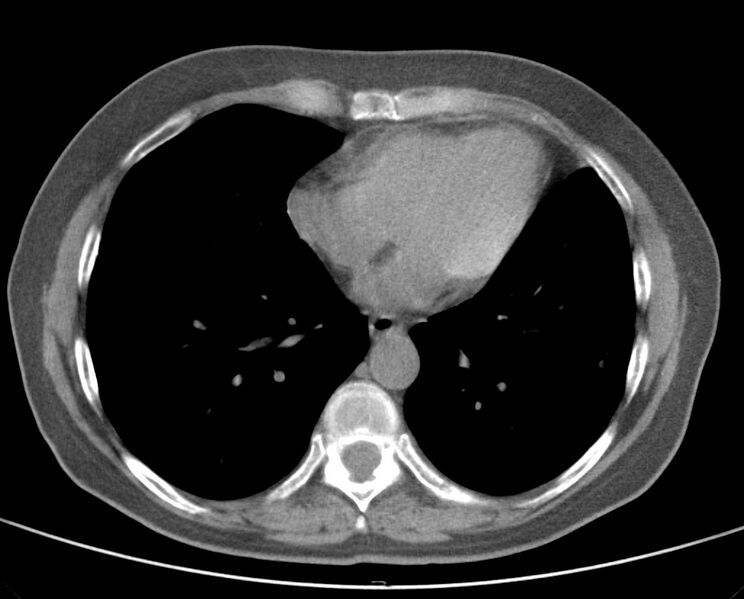 File:Adenosquamous lung carcinoma (Radiopaedia 22035-22030 non-contrast 40).jpg