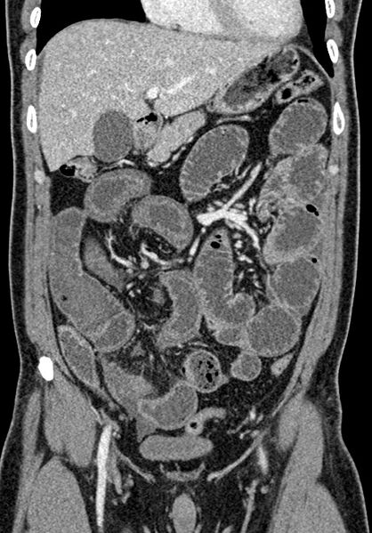 File:Adhesional small bowel obstruction (Radiopaedia 58900-66131 Coronal C+ portal venous phase 110).jpg