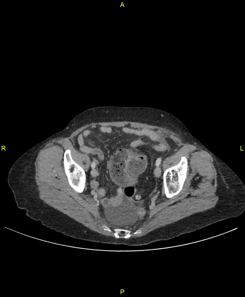 Adhesional small bowel obstruction (Radiopaedia 85402-101024 Axial C+ portal venous phase 244).jpg