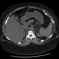 Adrenal myelolipoma (Radiopaedia 8216-9068 Axial non-contrast 11).jpg