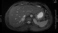 Adrenal pheochromocytoma (Radiopaedia 35133-36730 Axial T2 fat sat 1).jpg