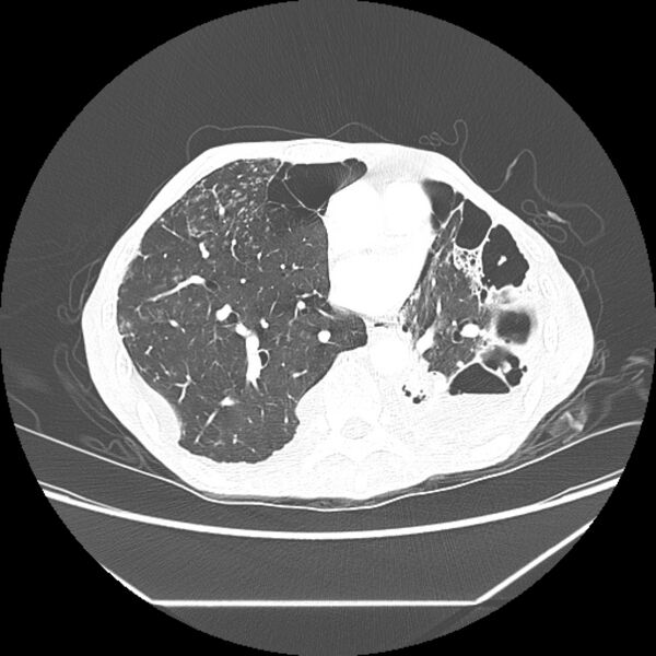 File:Advanced pulmonary tuberculosis (Radiopaedia 8599-9431 Axial lung window 32).jpg